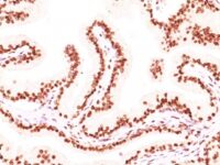 FFPE human prostate carcinoma sections stained with 100 ul anti-Androgen Receptor (clone AR441 + DHTR/882) at 1:50. HIER epitope retrieval prior to staining was performed in 10mM Tris 1mM EDTA, pH 9.0.